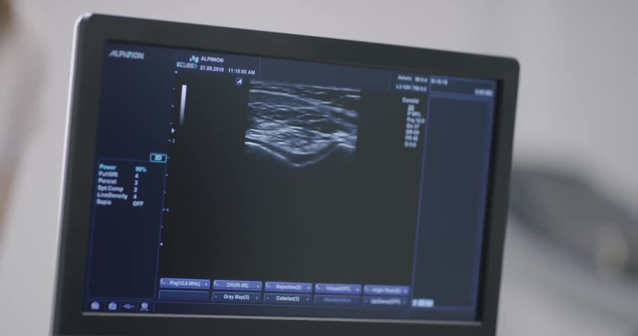 A screen with an ultrasound image on it