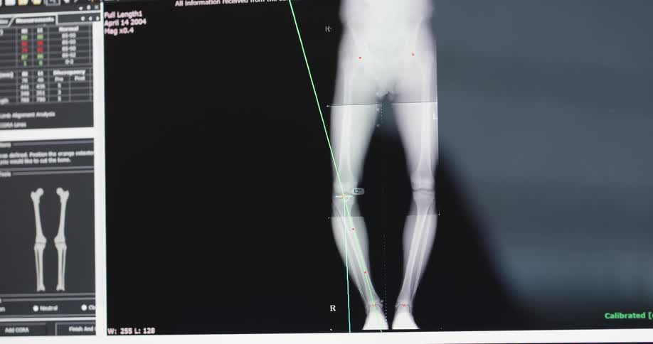 Different views of x rays of legs are cycled through on screen