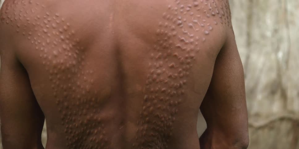 A man with a scaring pattern