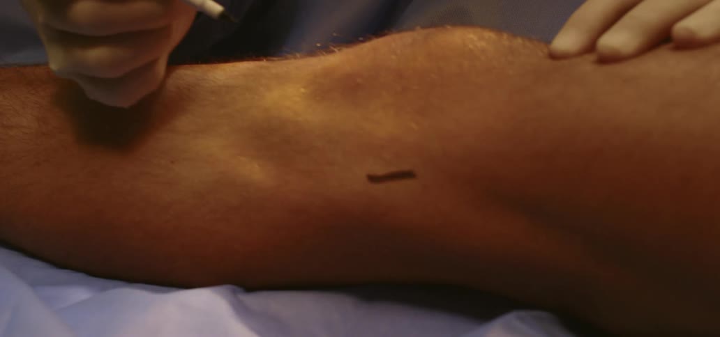 Surgeon marks an incision point with a marker on a patient knee