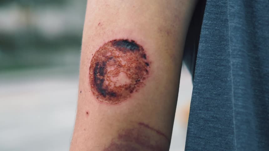 A large burn mark and bruise on a persons arm