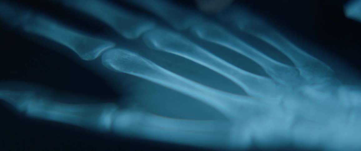 A finger touches an x-ray of a hand