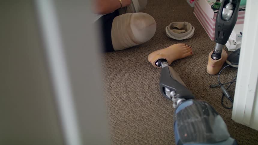 A woman prepares to put on prosthetic legs