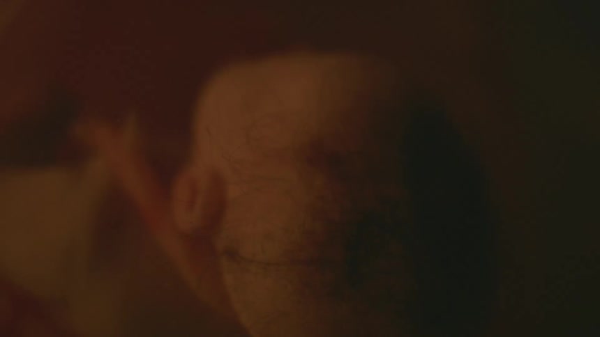 A nearly full term fetus has hair sporadically growing on its head
