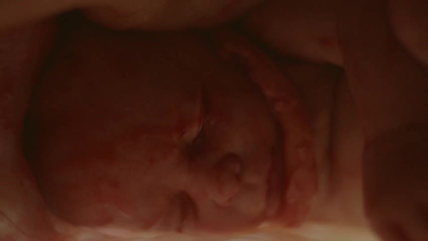 Entanglement of the cord wrapping around the babys neck in mothers womb