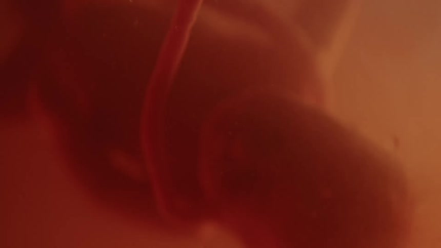 Entanglement of the cord wrapping around the babys neck in mothers womb