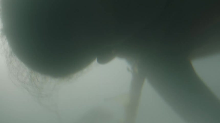 Entanglement of the cord wrapping around the babys neck in mothers womb