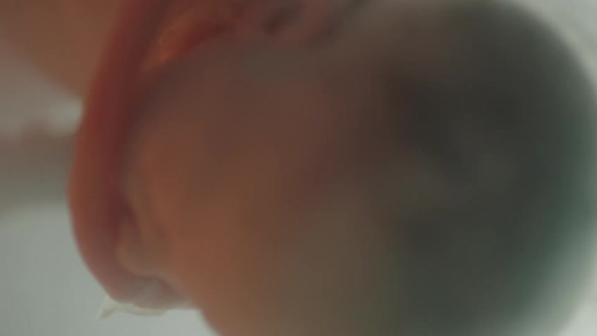 Entanglement of the cord wrapping around the babys neck