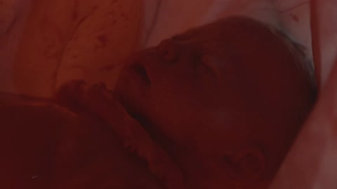 Entanglement of the cord wrapping around the babys neck in the womb