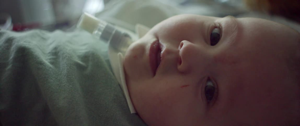 Close up of the face of a smiling baby with an intubated tracheoctomy