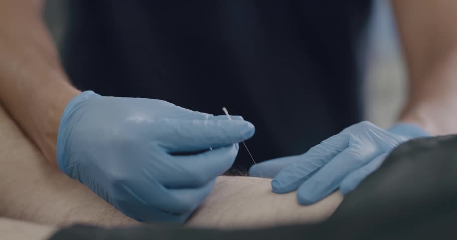 A patient is receiving acupuncture treatment