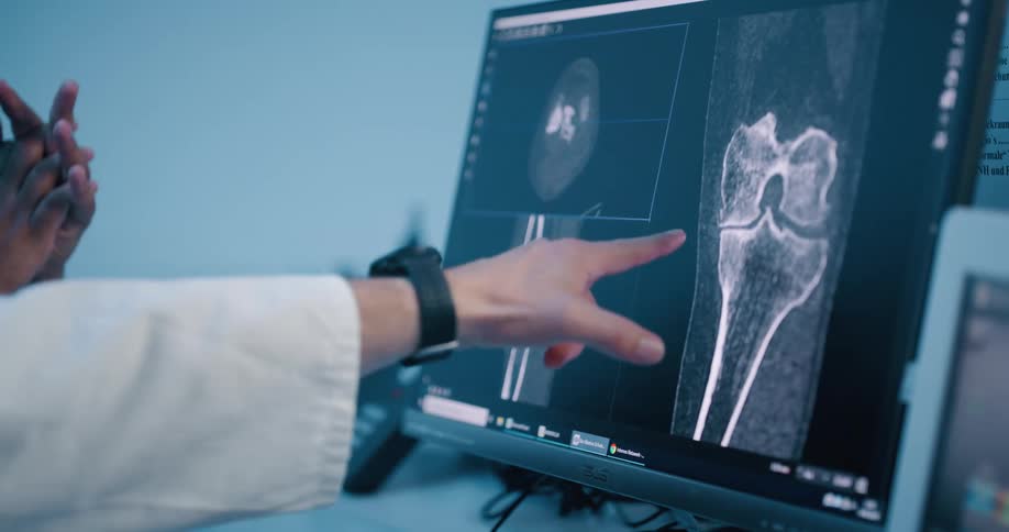A doctor pointing at a knee xray on a computer monitor