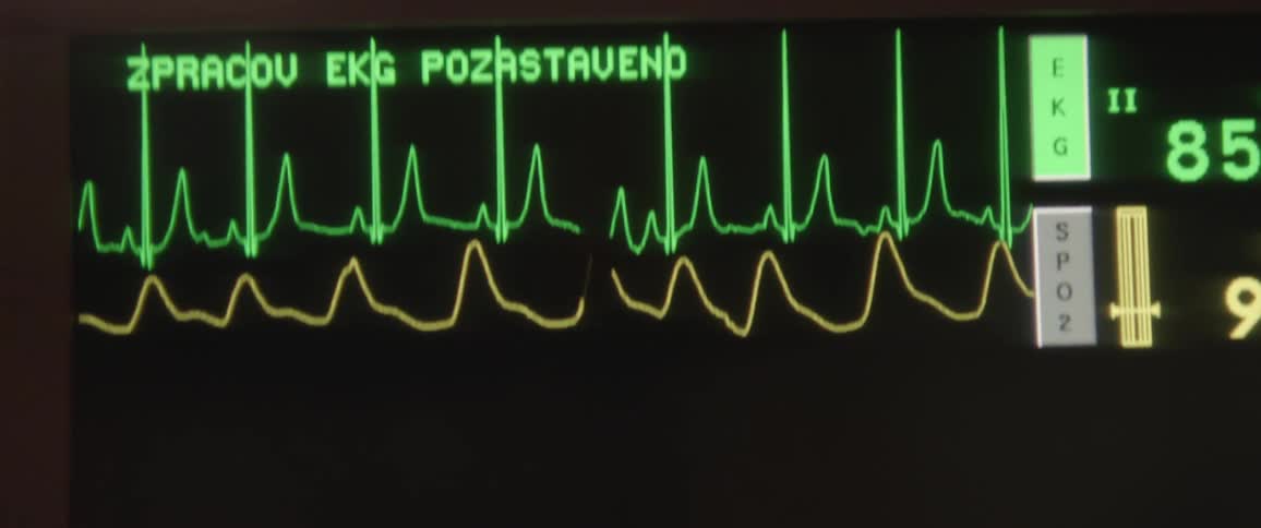 Heartbeat monitor screen displaying information in yellow and green on a black background