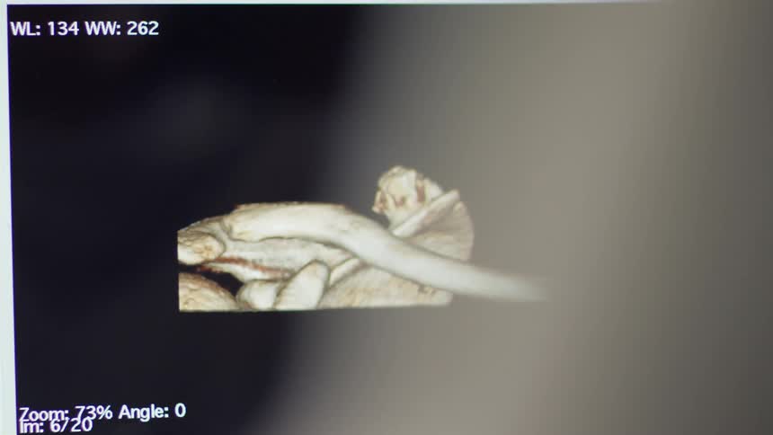 A fetus is shown on a monitor during a 3d ultrasound