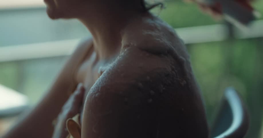 Man sprays and spreads medicated spray on woman suffering from sunburn