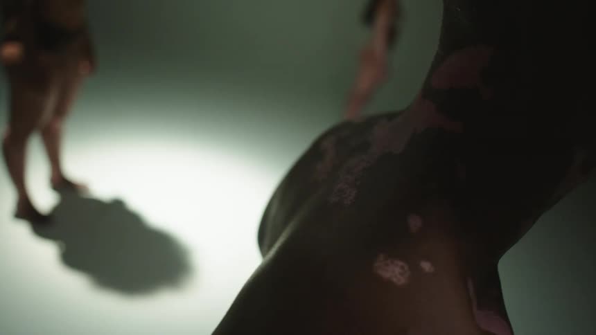 People with vitiligo skin condition stand in the room unclothed