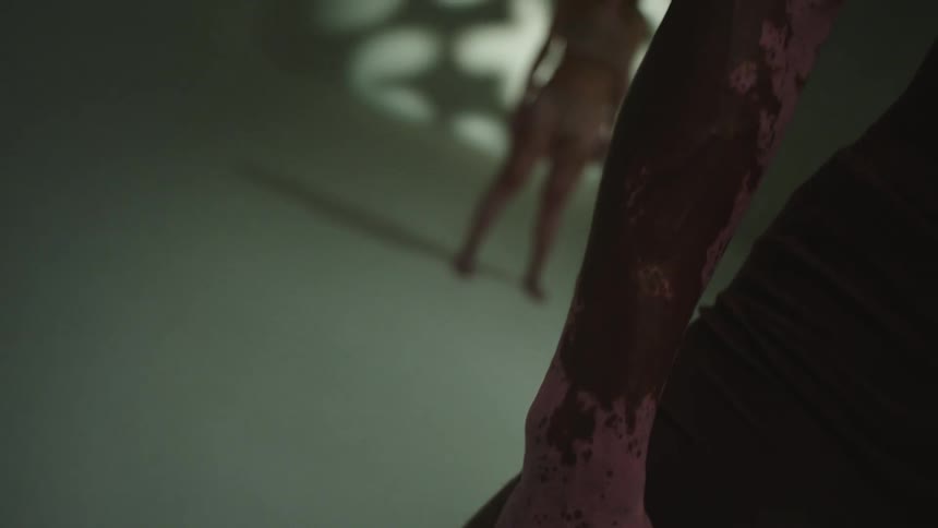 A man covered in discolored spots stands in a room in front of a woman standing in her under garments