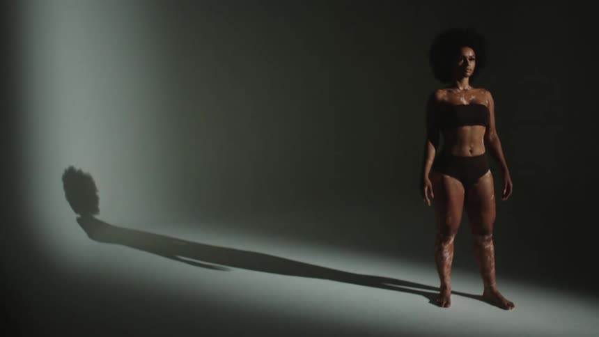 Female model with curly hair black underwear and vitiligo skin stands still posing for camera in studio