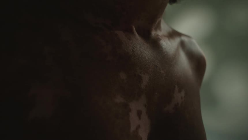 Woman with blotchy skin stands in dim room