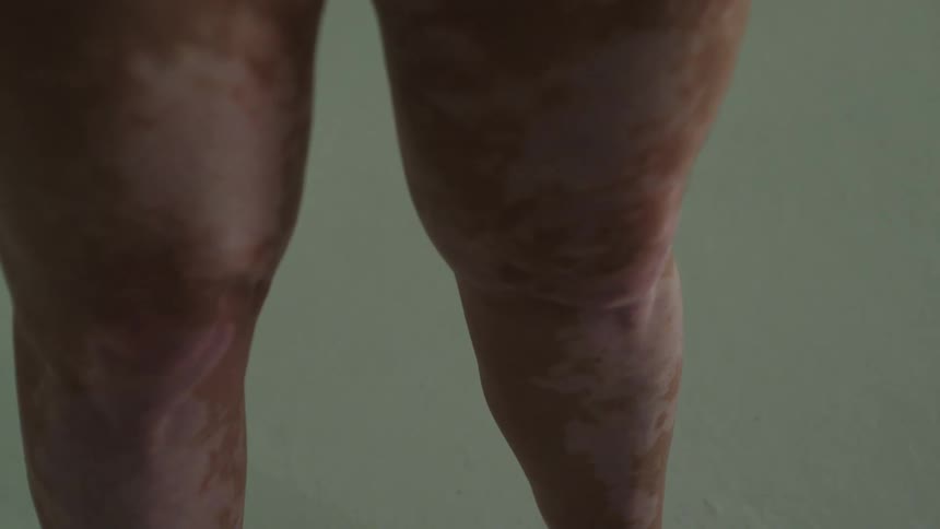 A womans legs are covered with discolored spots