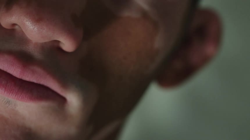 Close up of mans face with vitiligo skin in studio