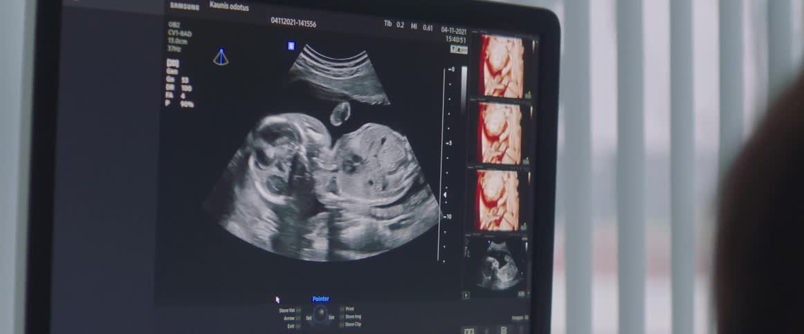 The sonogram is displayed on the monitor
