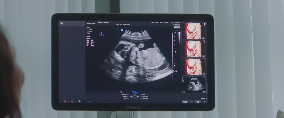 The display shows a sonogram of a baby