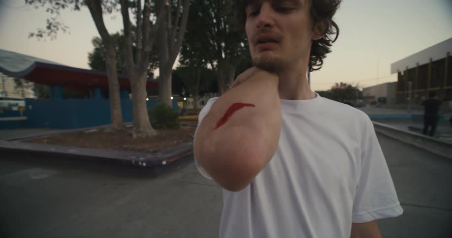 Man stands in city skate park examining bleeding injury on his arm