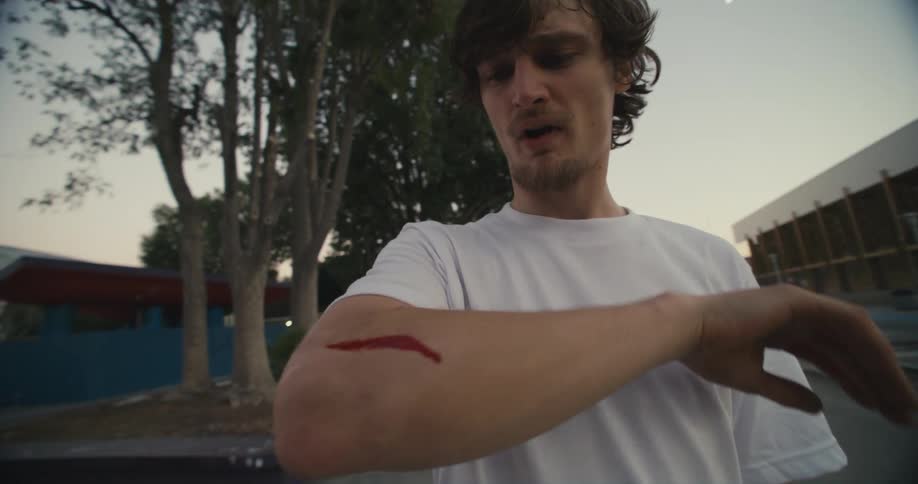 A young man at a park lifts up his arm and looks at a big cut