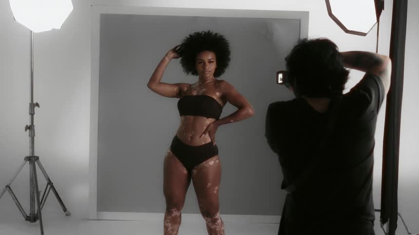 A photographer takes photos of a female model with vitiligo wearing undergarments