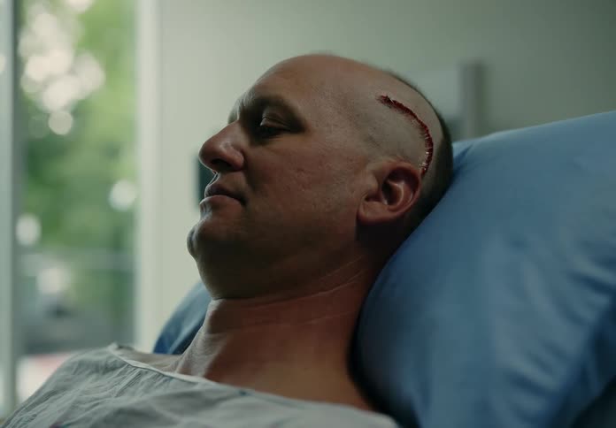 Patient of brain surgery with a freshly sutured wound on his temple rests on a hospital bed
