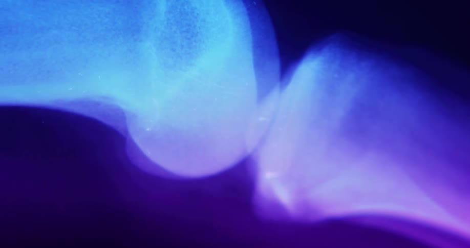 An xray of a persons bones and a joint enhanced by a blue and purple light