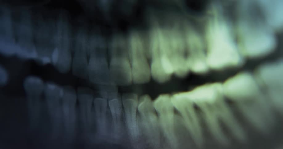 An xray of a patients teeth