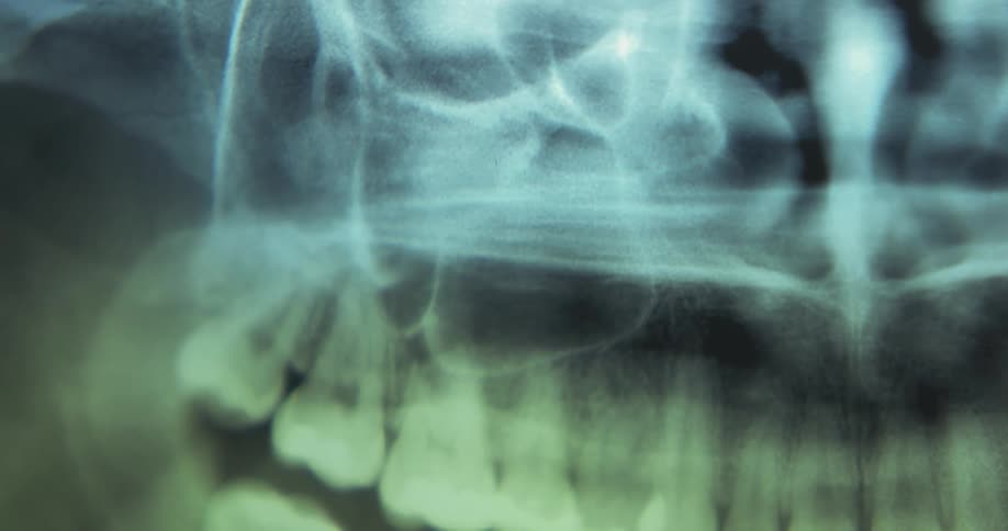 This is a scan of some ones x ray of there mouth
