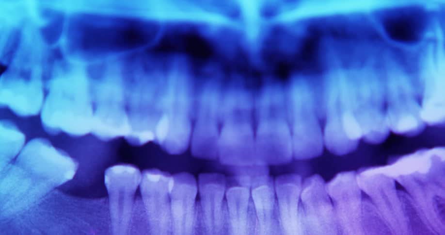 A dental xray of a persons teeth in their mouth
