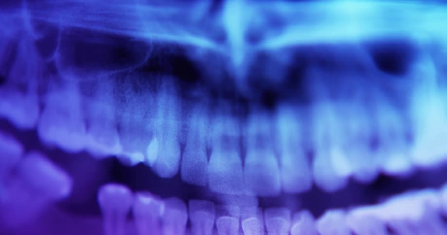 An xray of a persons teeth in their mouth illuminated by blue and purple light