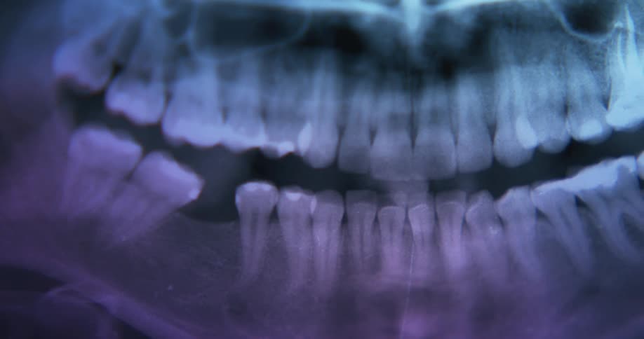 A dental x ray showing a mouthful of teeth