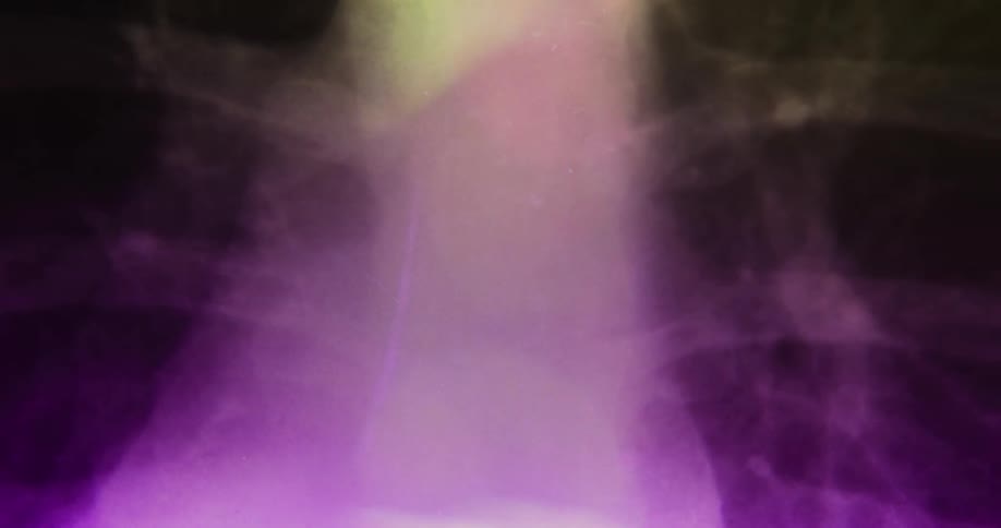 Light shining through an x ray film showing shadows of rib bones