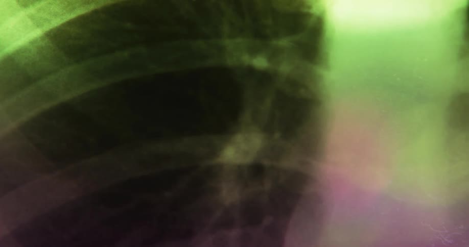 Green and pink light shines on an xray of a persons ribs