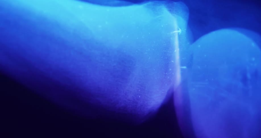 An xray of a persons bones and a joint enhanced by a blue light