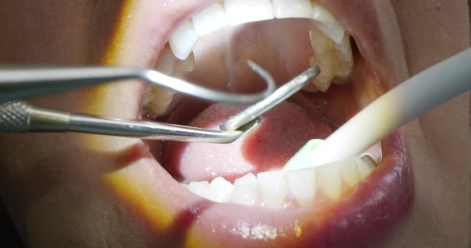 Dental equipment probing in a patients mouth