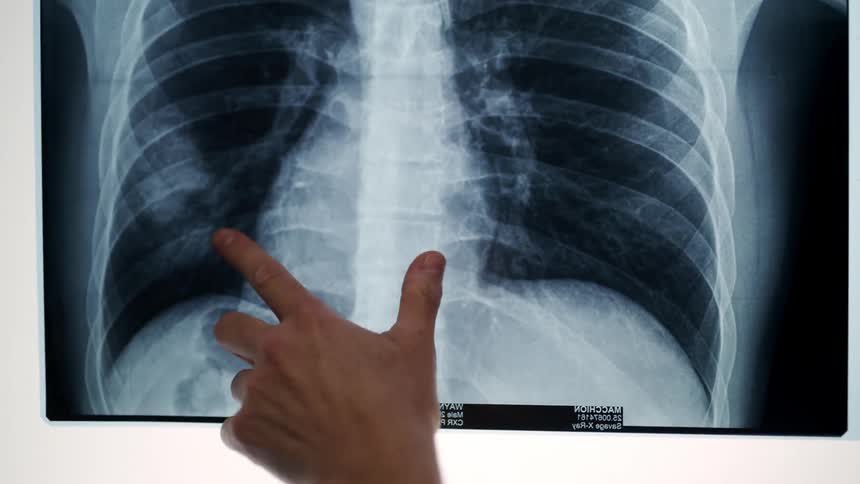 A person pointing at a xray