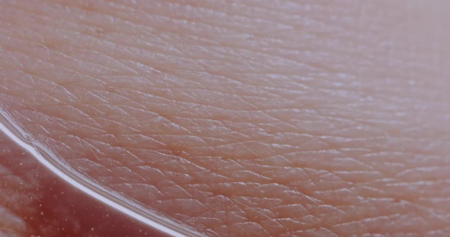 A viscous liquid bubbles on the surface of a persons skin