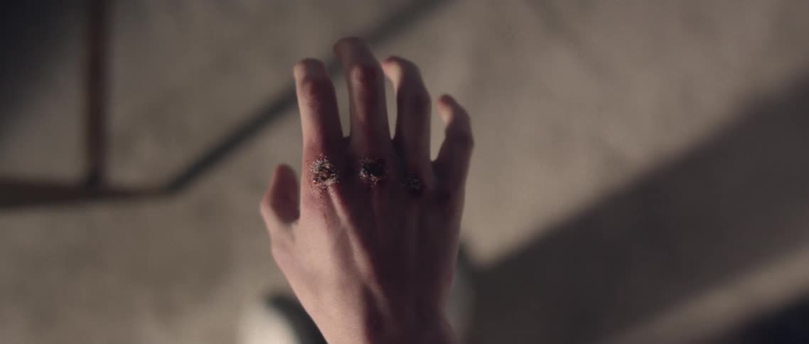 A person gingerly flexing the wounded knuckles on their hand