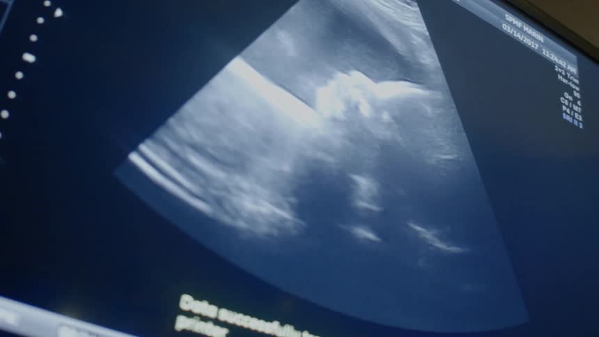 The display is showing an ultrasound