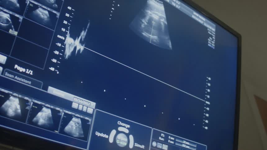 A heartbeat and image are showing on a sonogram