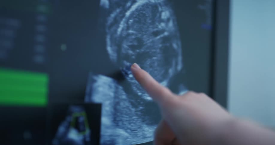 A monitor screen with an ultrasound image