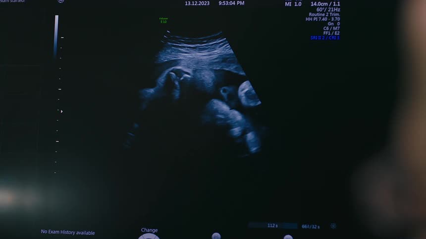 A screen with an ultrasound of a baby moving and it is black and white