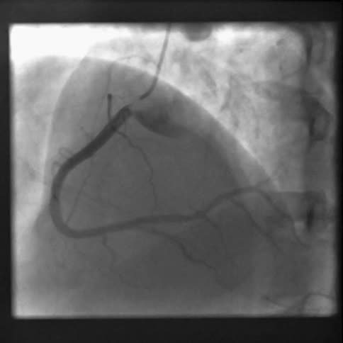 Surgical camera view performing an internal procedure