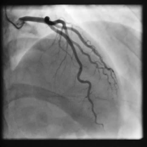 Medical camera of a small needle infiltrating the lung and veins in a surgical procedure